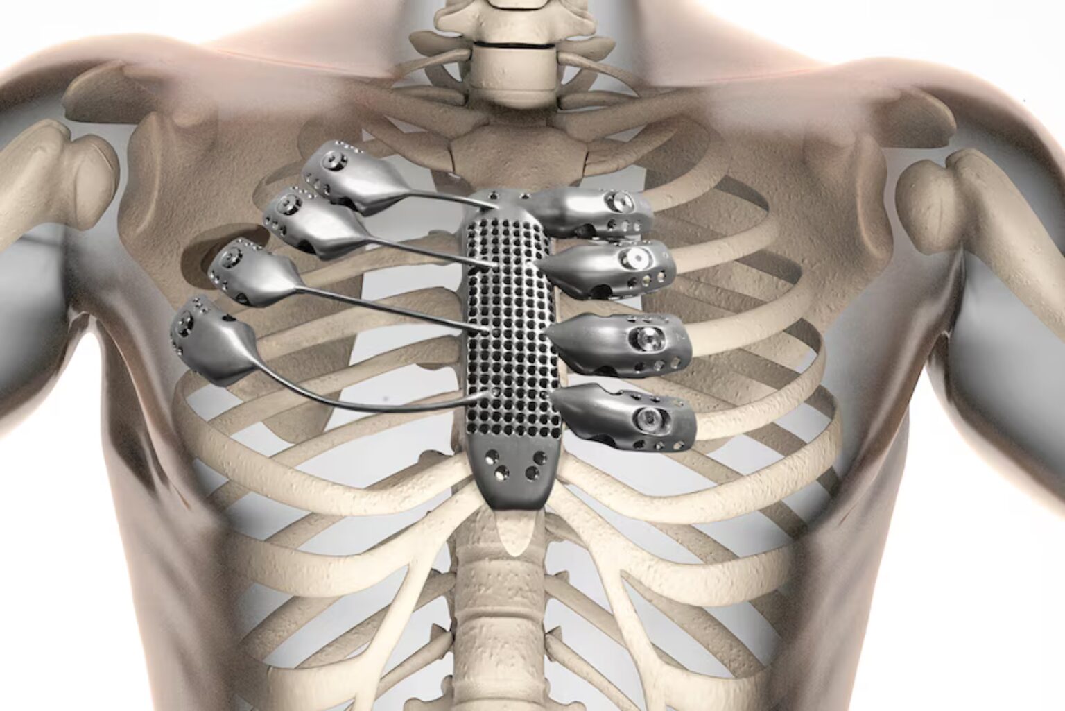 3D Printed Ribcage | Anatomics, Lab22, Salamanca University Hospital ...